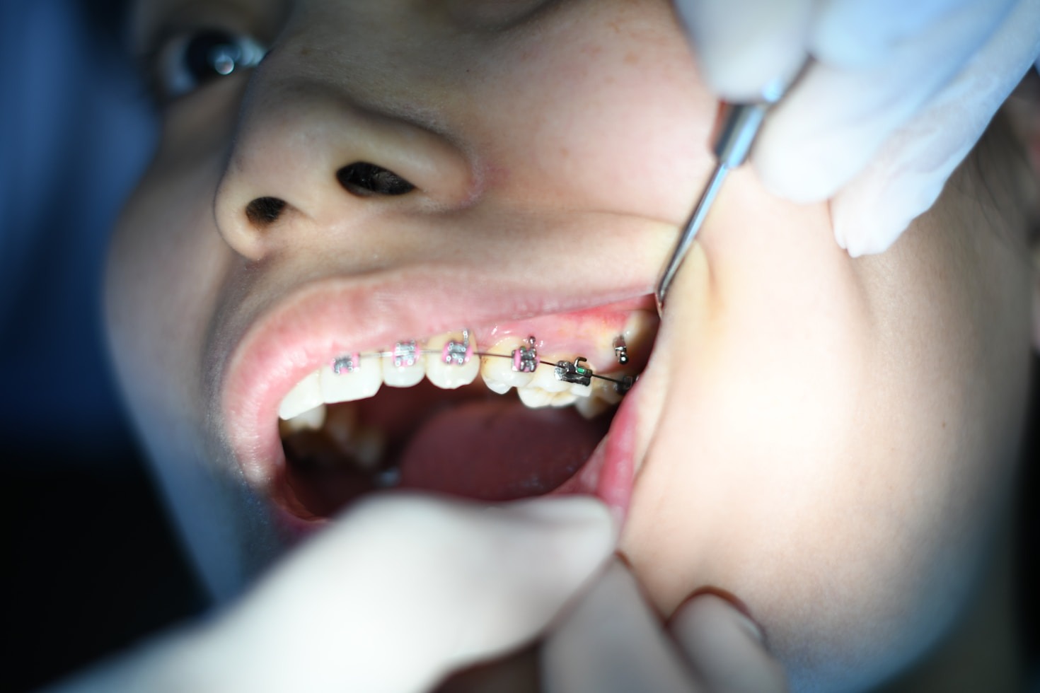 Implantes dentales: soluciones permanentes para tus dientes